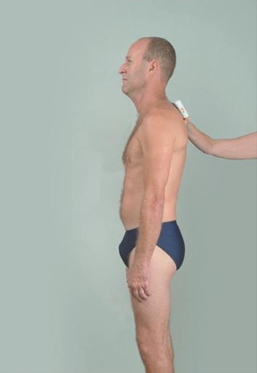 Kyphosis